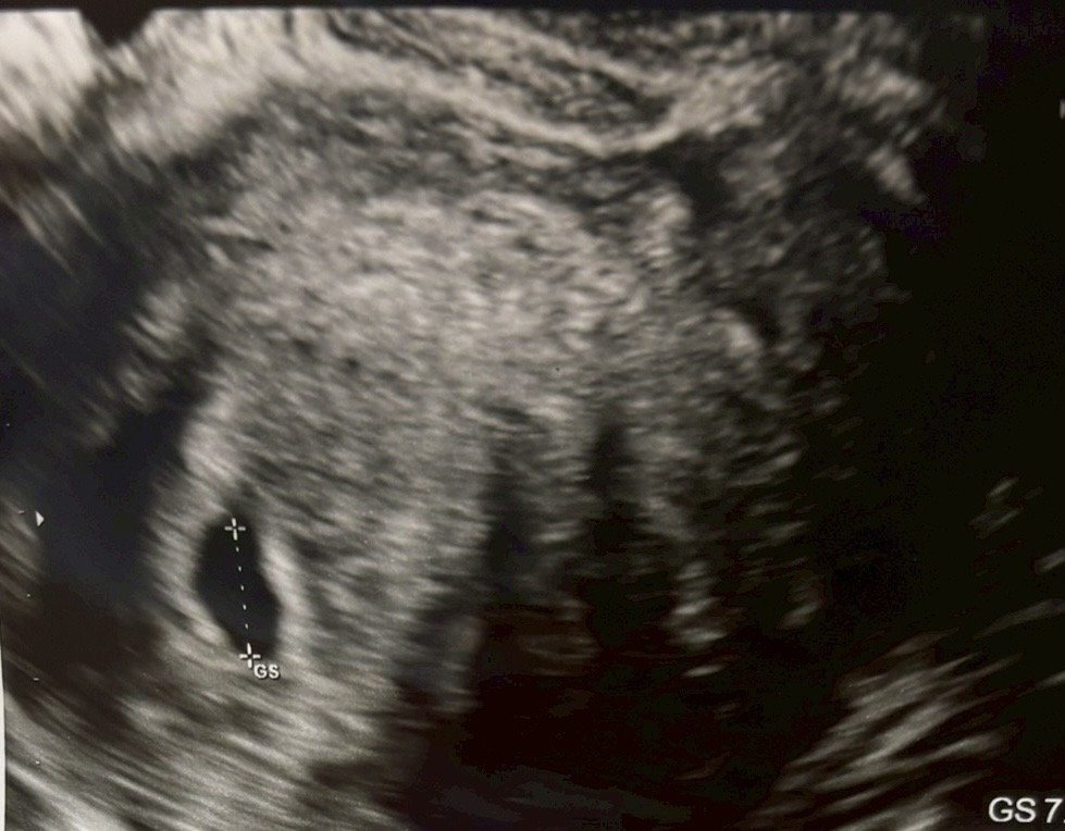 5 Things You Should Know About Miscarriages – What I’ve Learned